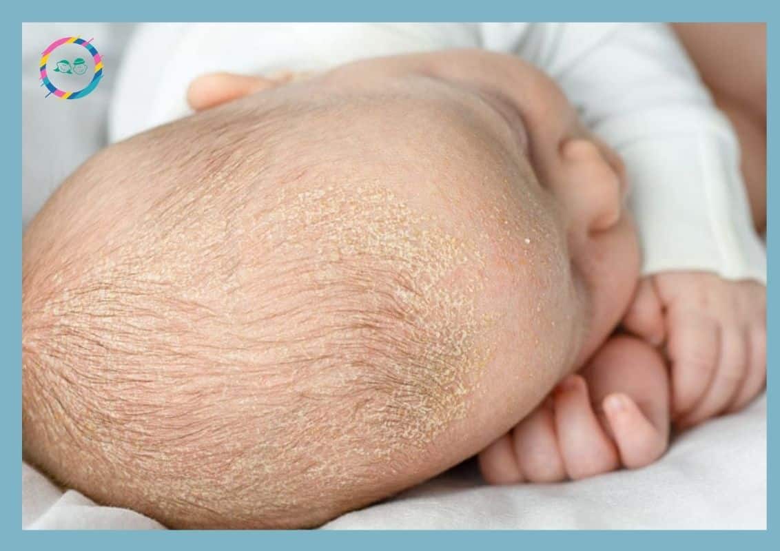 cứt trâu ở đầu trẻ